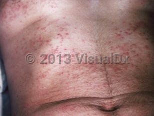 Clinical image of Seabather's eruption - imageId=253952. Click to open in gallery.  caption: 'Myriads of erythematous papules on the trunk (areas that were beneath a bathing suit).'