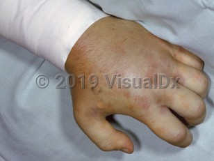 Clinical image of Pit viper snake envenomation - imageId=2543680. Click to open in gallery.  caption: 'Marked edema and ecchymotic discoloration of the hand.'