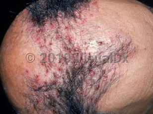 Clinical image of Folliculitis decalvans - imageId=2544397. Click to open in gallery.  caption: 'Perifollicular papules and crusting with associated surrounding scarring alopecia on the scalp.'