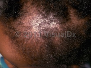 Clinical image of Drug-induced alopecia - imageId=255411. Click to open in gallery.  caption: 'Decreased hair density on the frontal scalp.'