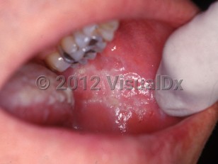 Clinical image of Chronic cheek chewing - imageId=2556547. Click to open in gallery.  caption: 'A ragged plaque on the buccal mucosa.'