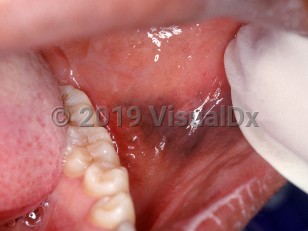 Clinical image of Multifocal or diffuse mucosal pigmentation - imageId=2556932. Click to open in gallery.  caption: 'A dark brown patch on the buccal mucosa.'