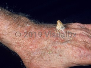 Clinical image of Cutaneous horn - imageId=2558403. Click to open in gallery.  caption: 'A triangular-shaped keratotic projection arising from the dorsal hand and surrounding scaly papules (actinic keratoses).'