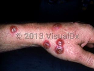 Clinical image of Cowpox - imageId=2569073. Click to open in gallery.  caption: 'Several round, vesiculated and crusted plaques, each with a bright pink rim, on the hand and forearm.'