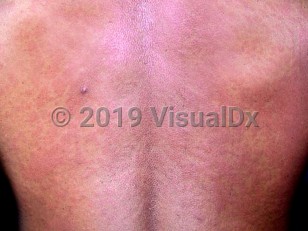 Clinical image of Human immunodeficiency virus primary infection - imageId=2583139. Click to open in gallery.  caption: 'Widespread erythematous papules and plaques on the back.'