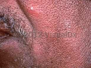 Clinical image of Kimura disease - imageId=2584062. Click to open in gallery.  caption: 'Erythematous nodules on the medial cheek.This patient also had cervical lymphadenopathy and peripheral eosinophilia of 16%.'