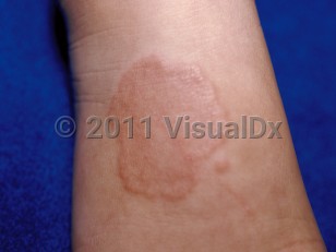 Clinical image of Granuloma annulare