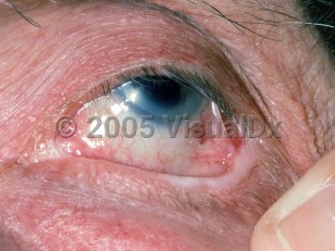Clinical image of Ocular cicatricial pemphigoid - imageId=2597567. Click to open in gallery.  caption: 'Fibrotic scarring of the palpebral to the bulbar conjunctiva (symblepharon).'