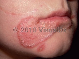 Clinical image of Tinea faciei - imageId=261440. Click to open in gallery.  caption: 'An annular, pink, scaly, and crusted plaque on the chin and a similar nearby papule.'