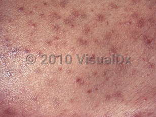 Clinical image of Pityrosporum folliculitis - imageId=2622307. Click to open in gallery.  caption: 'A close-up of several follicularly based brown papules and a few tiny pustules with some postinflammatory hyperpigmentation, in an immunocompromised patient.'