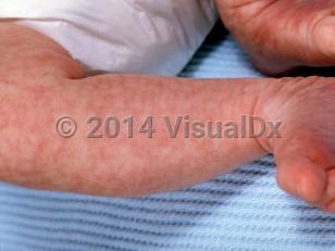 Clinical image of Cutis marmorata - imageId=264191. Click to open in gallery.  caption: 'Diffuse reticulate erythematous patches on the legs.'