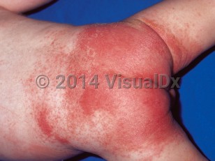 Clinical image of Diaper irritant contact dermatitis