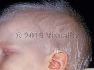 Clinical image of Oculocutaneous albinism - imageId=2643647. Click to open in gallery.  caption: 'Diffuse lack of pigment in the skin and silver-white hair.'