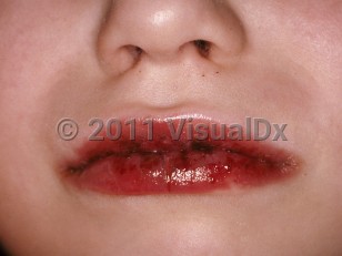 Clinical image of Kawasaki disease - imageId=266240. Click to open in gallery.  caption: 'Erosions and hemorrhagic crusting on the lips.'
