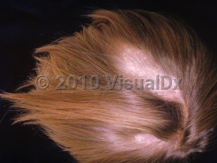 Clinical image of Trichotillomania - imageId=2672028. Click to open in gallery.  caption: 'Large patterned patches of nonscarring alopecia with hair regrowth and associated crusting on the scalp.'
