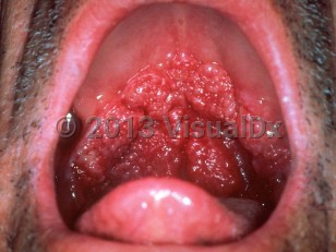 Clinical image of Mucosal leishmaniasis - imageId=268093. Click to open in gallery.  caption: 'A large exophytic plaque with a papillated surface on the hard and soft palate.'