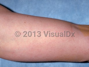 Clinical image of Onchocerciasis - imageId=268991. Click to open in gallery.  caption: 'Subtle erythematous papules and patches on the arm.'