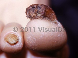 Clinical image of Onychogryphosis - imageId=2696890. Click to open in gallery.  caption: 'A markedly thickened, elongated, brown, horn-like great toenail with an abnormal curvature. Note earlier similar changes of the second toenail.'