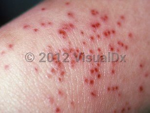 Clinical image of Eczema herpeticum - imageId=270255. Click to open in gallery.  caption: 'A close-up of many discrete and confluent, monomorphic crusts and a few outlying vesicles.'