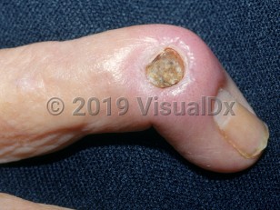Clinical image of Osteomyelitis - imageId=2702877. Click to open in gallery. 