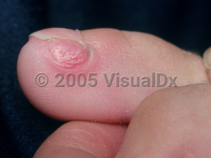 Clinical image of Subungual exostosis - imageId=2704448. Click to open in gallery.  caption: 'A pink papule on the nailbed with resultant paronychia.'