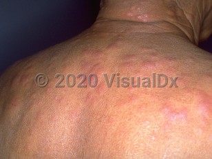 Clinical image of Type 1 lepra reaction - imageId=271424. Click to open in gallery.  caption: 'Numerous edematous pink papules and plaques on the posterior neck and back.'