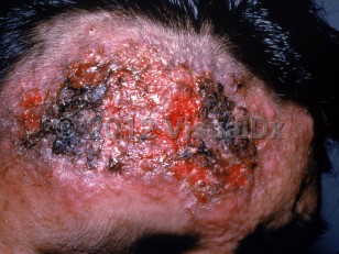Clinical image of Botryomycosis - imageId=2717110. Click to open in gallery. 