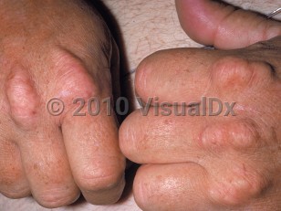 Clinical image of Xanthoma tendinosum