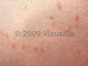 Clinical image of Enteric fever - imageId=2721479. Click to open in gallery. 