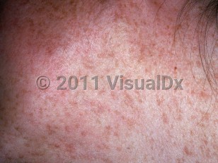 Clinical image of Reticulate pigmented anomaly of flexures - imageId=2722751. Click to open in gallery.  caption: 'Multiple light brown macules on the lateral neck.'