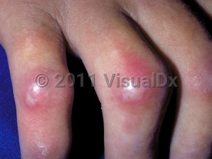 Clinical image of Scleroderma - imageId=272375. Click to open in gallery.  caption: 'Bound-down skin over the digits with scars and surrounding erythema over the knuckles.'