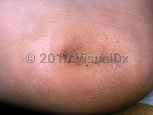Clinical image of Talon noir - imageId=2724295. Click to open in gallery.  caption: 'A light brown patch with black and gray peppering on the heel.'