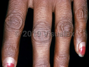 Clinical image of Addison disease - imageId=2729975. Click to open in gallery.  caption: 'Hyperpigmented patches on the dorsal fingers.'