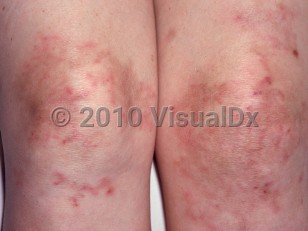 Clinical image of Polyarteritis nodosa - imageId=2732508. Click to open in gallery.  caption: 'Retiform, erythematous plaques with central brown patches on the knees.'