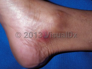 Clinical image of Disseminated gonorrhea - imageId=273456. Click to open in gallery.  caption: 'A grayish cloudy vesicle on a purpuric base near the ankle.'