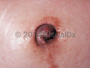 Clinical image of Cutaneous endometriosis