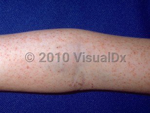 Clinical image of Rocky Mountain spotted fever