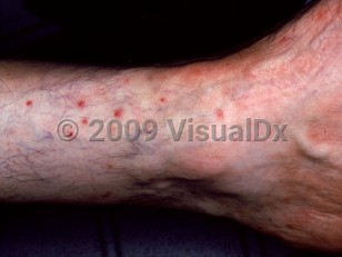 Clinical image of Chigger bite