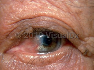 Clinical image of Ocular pterygium - imageId=275150. Click to open in gallery.  caption: 'A whitish-gray plaque with overlying telangiectasias extending over the nasal bulbar conjunctiva, iris, and pupil.'