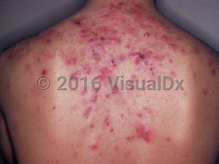 Clinical image of Acne fulminans - imageId=2760110. Click to open in gallery.  caption: 'Numerous brightly erythematous papules and nodules, many crusted, on the upper back.'