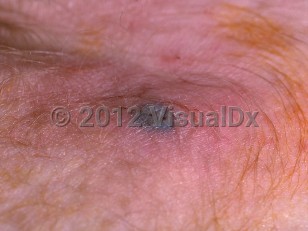 Clinical image of Bacterial sepsis - imageId=276067. Click to open in gallery.  caption: 'A close-up of a hemorrhagic vesicle and surrounding pink erythema.'