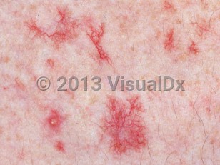 Clinical image of Telangiectasia - imageId=2767459. Click to open in gallery.  caption: 'A close-up of linear and branching red macules (and unrelated pustules).'