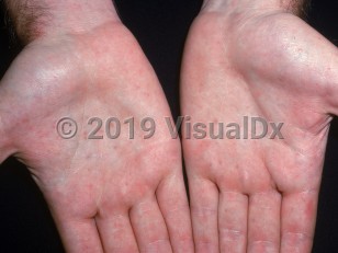 Clinical image of Basal cell nevus syndrome - imageId=2771016. Click to open in gallery.  caption: 'Numerous tiny pits on the palms.'