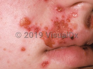 Clinical image of Nonbullous impetigo - imageId=277147. Click to open in gallery.  caption: 'Numerous discrete and confluent, honey-colored crusts, some hemorrhagic crusts, and surrounding erythema on and around the lips.'
