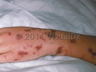 Clinical image of Purpura fulminans - imageId=277439. Click to open in gallery.  caption: 'Retiform, purpuric, and necrotic papules and plaques on the arm and hand.'