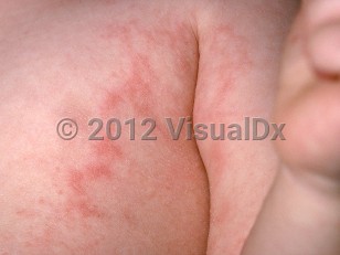 Clinical image of Unilateral laterothoracic exanthem of childhood - imageId=278109. Click to open in gallery.  caption: 'Erythematous papules and plaques, some with a retiform configuration, on the trunk and arm.'
