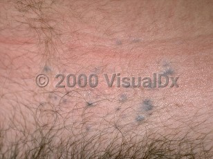 Clinical image of Glomangiomas - imageId=278270. Click to open in gallery.  caption: 'Multiple deep blue-gray macules and papules on the lower abdomen.'