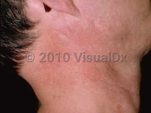 Clinical image of Poikiloderma of Civatte - imageId=278658. Click to open in gallery.  caption: 'Telangiectasias and some hyper- and hypopigmentation on the lateral neck.'