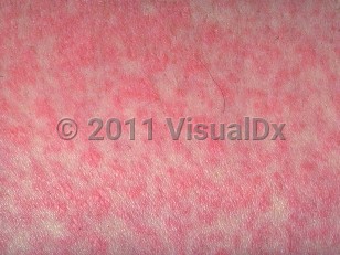 Clinical image of Viral exanthem - imageId=278979. Click to open in gallery.  caption: 'A close-up of bright pink papules becoming confluent to form plaques.'
