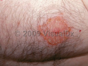 Clinical image of Nipple dermatitis